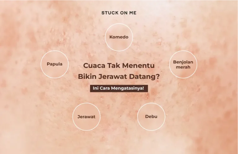 Cuaca Tak Menentu Bikin Jerawat Datang? Ini Cara Mengatasinya!